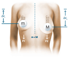 b Lite Implantat