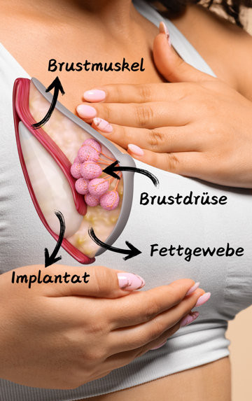 Lage Brustimplantat
