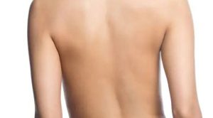 Bauchfettschürze entfernen