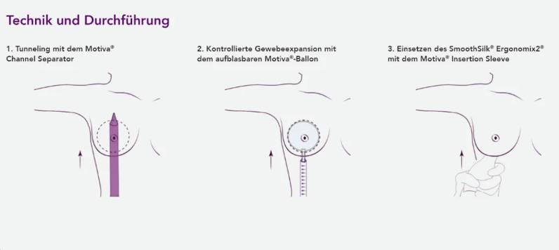 Chirurgische Techniken der Preservé™-Methode zur minimalinvasiven Brustvergrößerung.